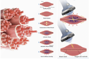 Acoustic Compression ShockWave Therapy WILL END YOUR PAIN IMMEDIATELY!